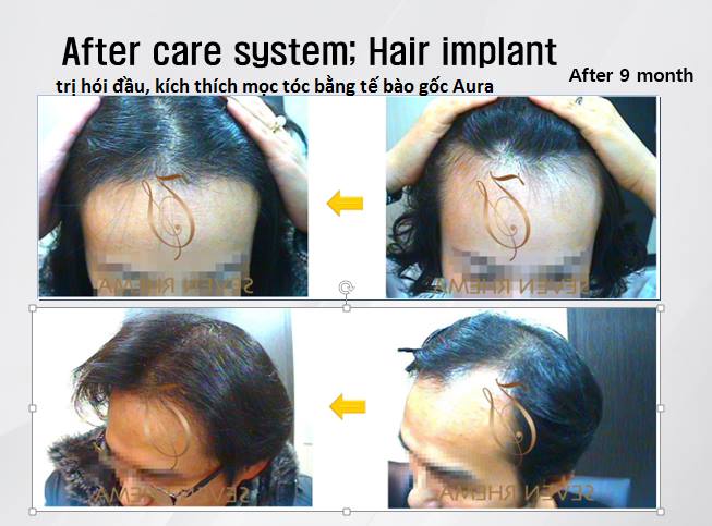 tế bào gốc kích thích mọc tóc và hổ trợ điều trị hói đầu aura hàn quốc